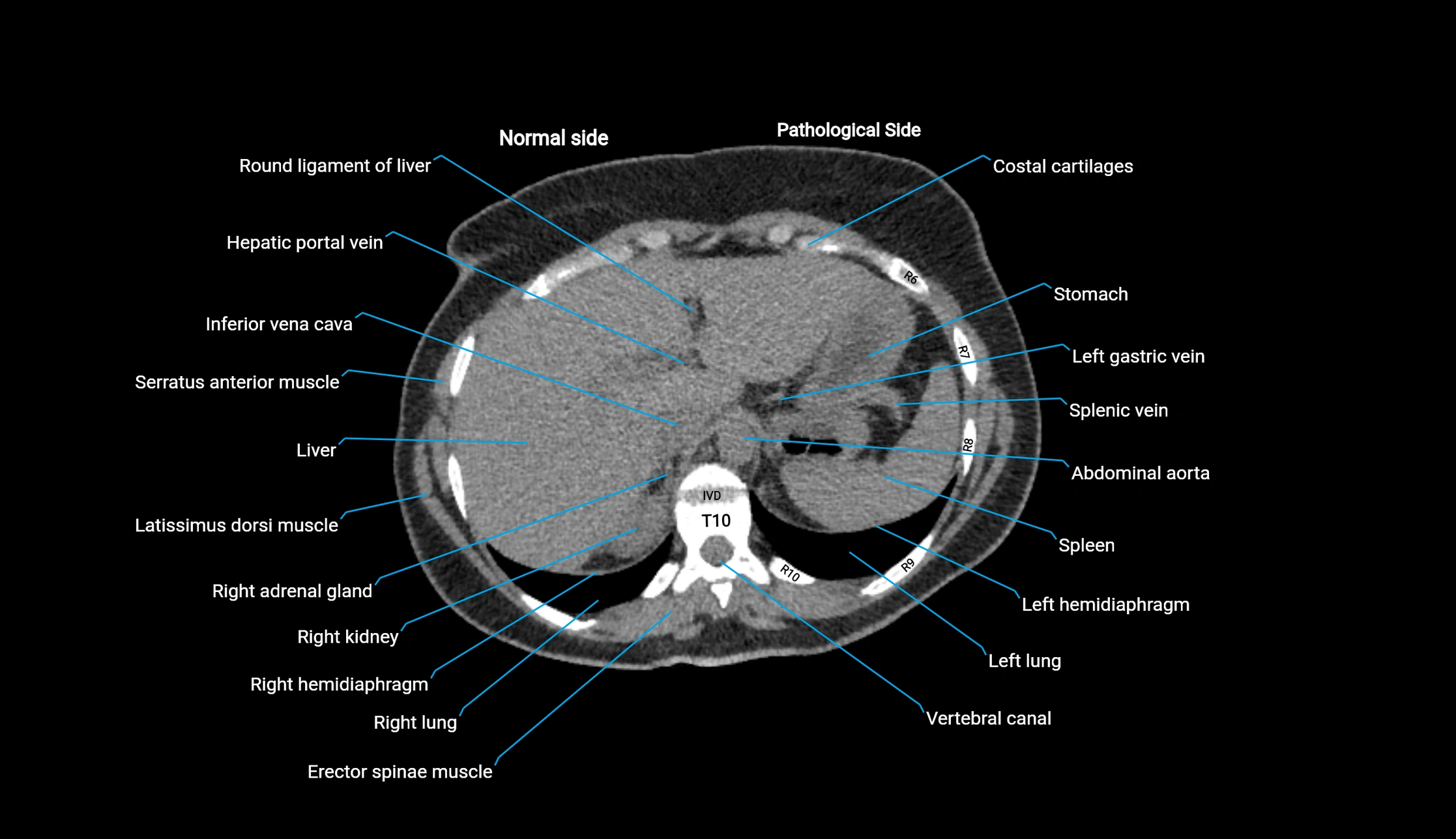CT KUB axial cross sectional anatomy  radiology image -img-00201-00011.webp